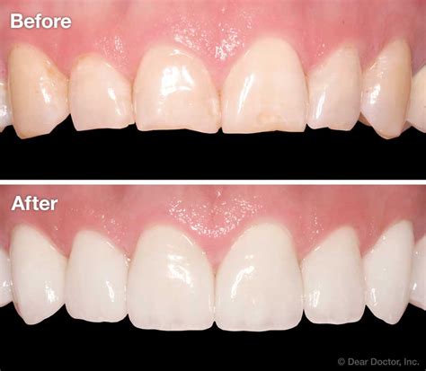 Do Veneers Stain Like Normal Teeth