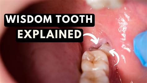 do wisdom teeth hurt other teeth