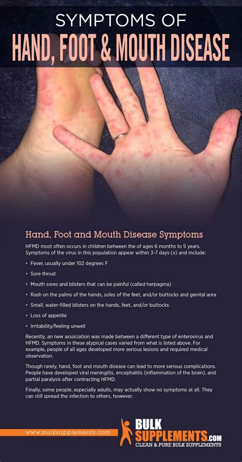 do you always get a rash with hand foot and mouth disease