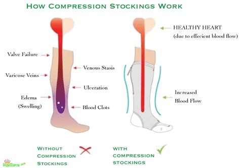 Do Zip Up Compression Socks Work