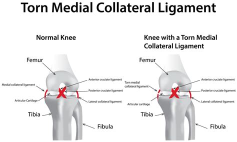 Do torn ligaments require surgery?