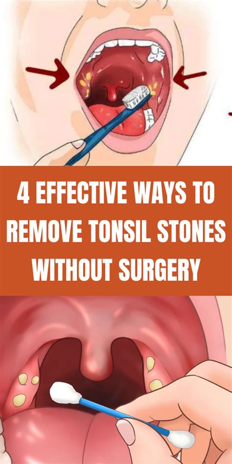 doctor tonsil stone removal