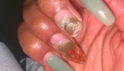 Does Acrylic Nails Cause Infection Nail Fungus And What Do You Need