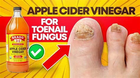 Does Apple Cider Vinegar Help Get Rid Of Toenail Fungus Apple Poster