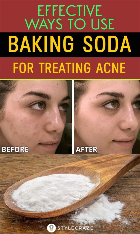 does baking soda help acne