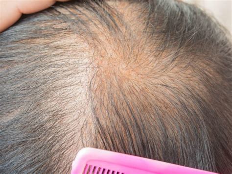 Treating Damaged Hair Follicles bravoairlines