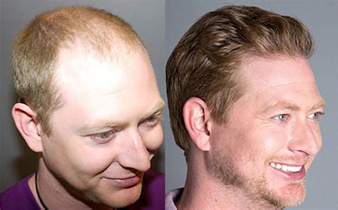 Hair Transplant Results 12 Month Timelapse Before and After Bosley