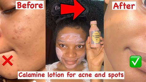 does calamine lotion help acne