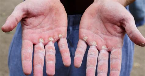 7 Home Remedies For Calluses on Your Hands That Anyone Can Use Home