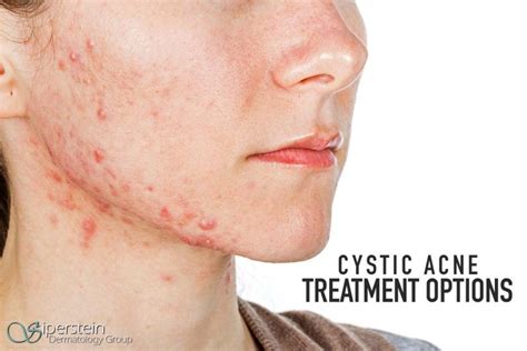 does cystic acne go away