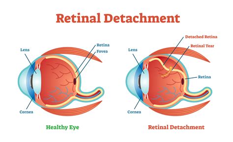 does diabetes cause retinal detachment