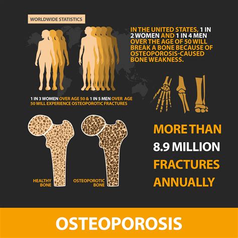 does everyone get osteoporosis