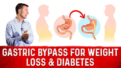 does gastric bypass cure diabetes
