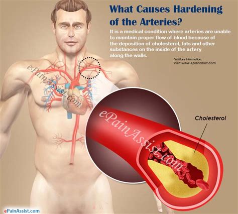 does hardening of the arteries cause dementia