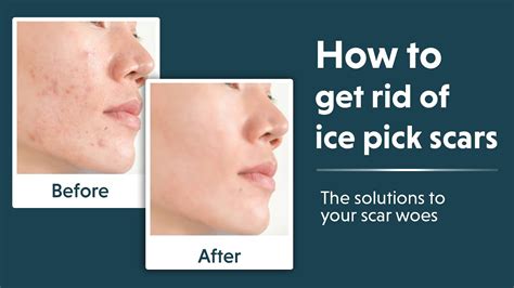 does ice help with acne scars