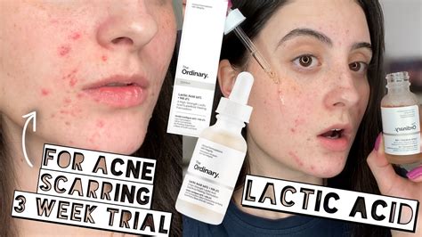 does lactic acid help with acne