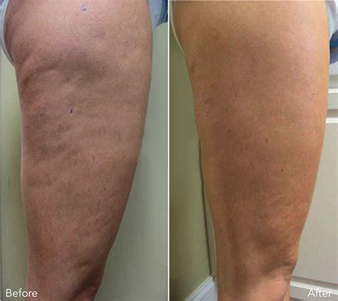 does lipo get rid of cellulite