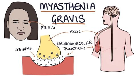 does myasthenia gravis cause dementia
