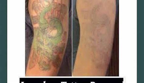 Does Tattoo Removal Work Completely The Cost Of In 2023 Bore Dodo