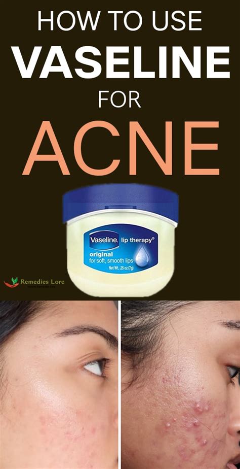 does vaseline help acne scars