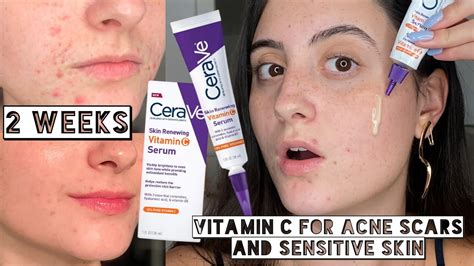 does vitamin c serum cause acne