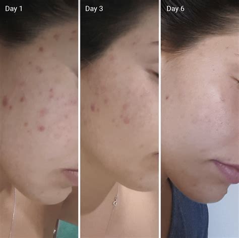 does vitamin c serum help with acne