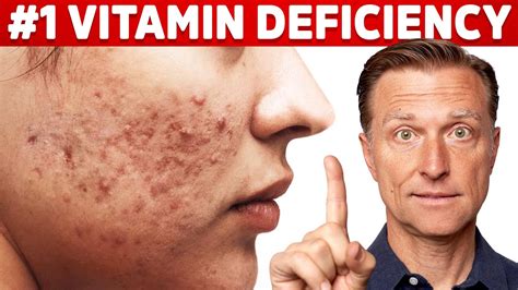 does vitamin d help acne