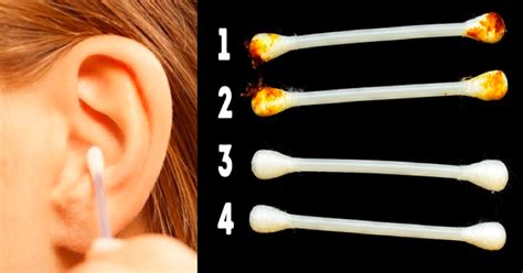 Earwax problems Symptoms, causes, risk factors, and treatment