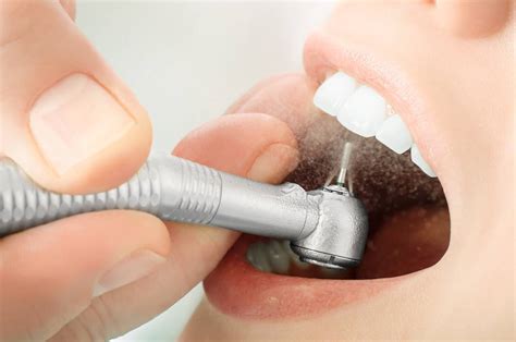 Does A Dental Cleaning Remove Stains