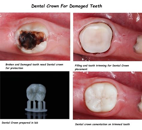 Cost of a Dentist Without Insurance What They Don’t Tell You