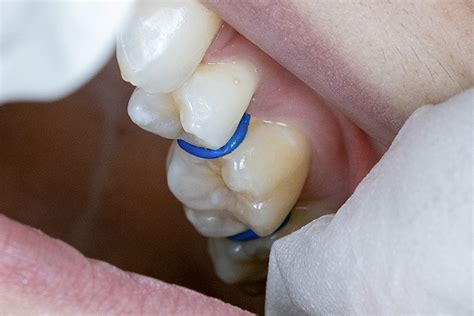 Cost of a Dentist Without Insurance What They Don’t Tell You