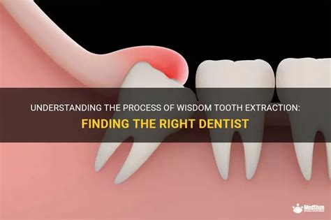 How Much Is It To Get A Tooth Removed Without Insurance Blog