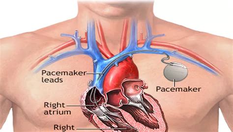 Does A Pacemaker Help Arrhythmia