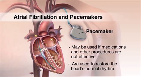 Does A Pacemaker Help With Afib