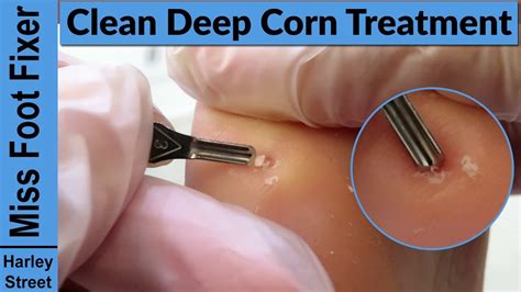 Does A Podiatrist Remove Corns