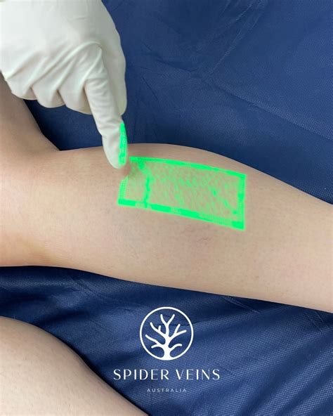 Does Acupuncture Work For Spider Veins