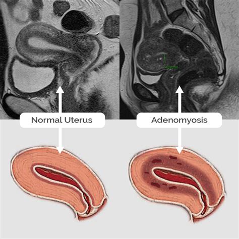 does adenomyosis cause infertility