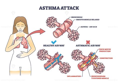 Does Air Conditioning Trigger Asthma
