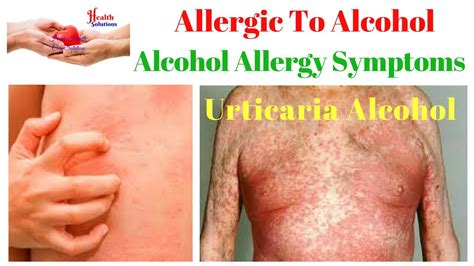 Does Alcohol Affect Allergy Testing