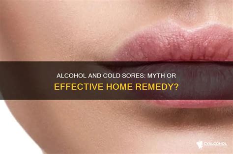 Does Alcohol Help With Cold Sores