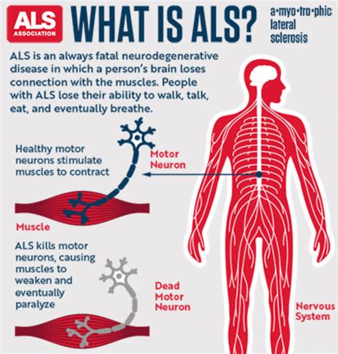 does als lead to death