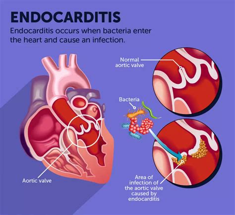 Does Antibiotics Cause Endocarditis