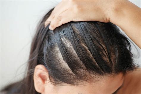 Does Anything Help Hair Loss  A Comprehensive Guide