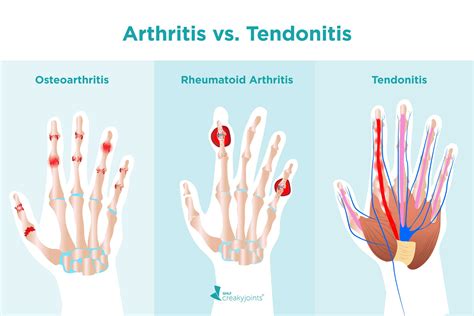 Does Arthritis Feel Like Tendonitis