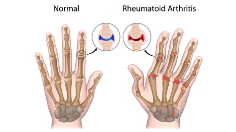 Does Arthritis Inherited