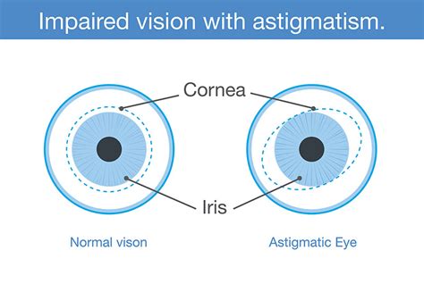 Can Astigmatism Disappear Without Surgery?