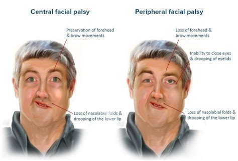 does bell's palsy spare the forehead