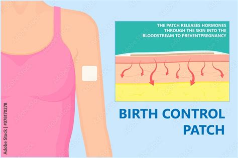 Does Birth Control Patch Prevent Pregnancy