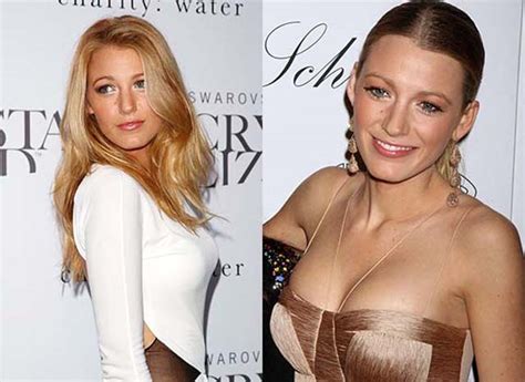 does blake lively have implants
