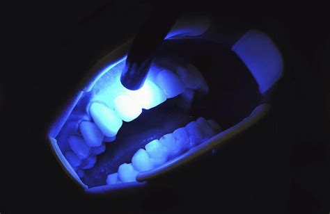 Does Blue Light Work On Teeth Without Gel
